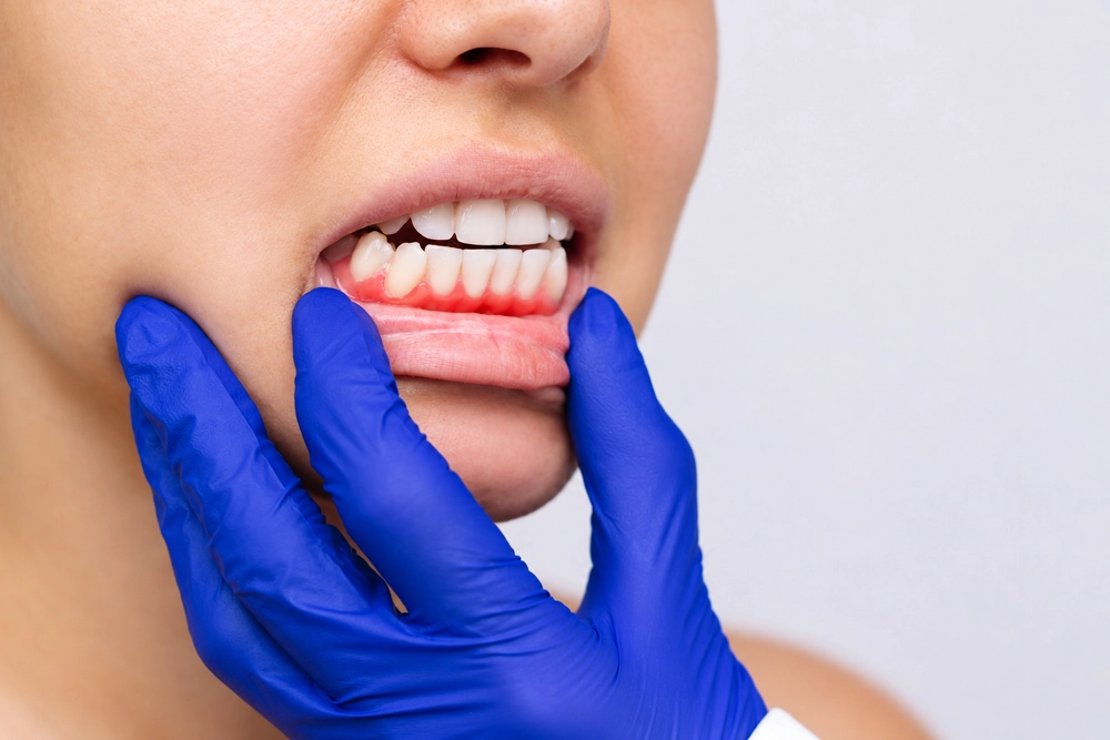 Gingivitis Nedir?