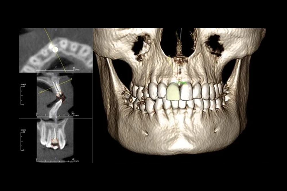 Üç Boyutlu Çene ve Diş Tomografisi