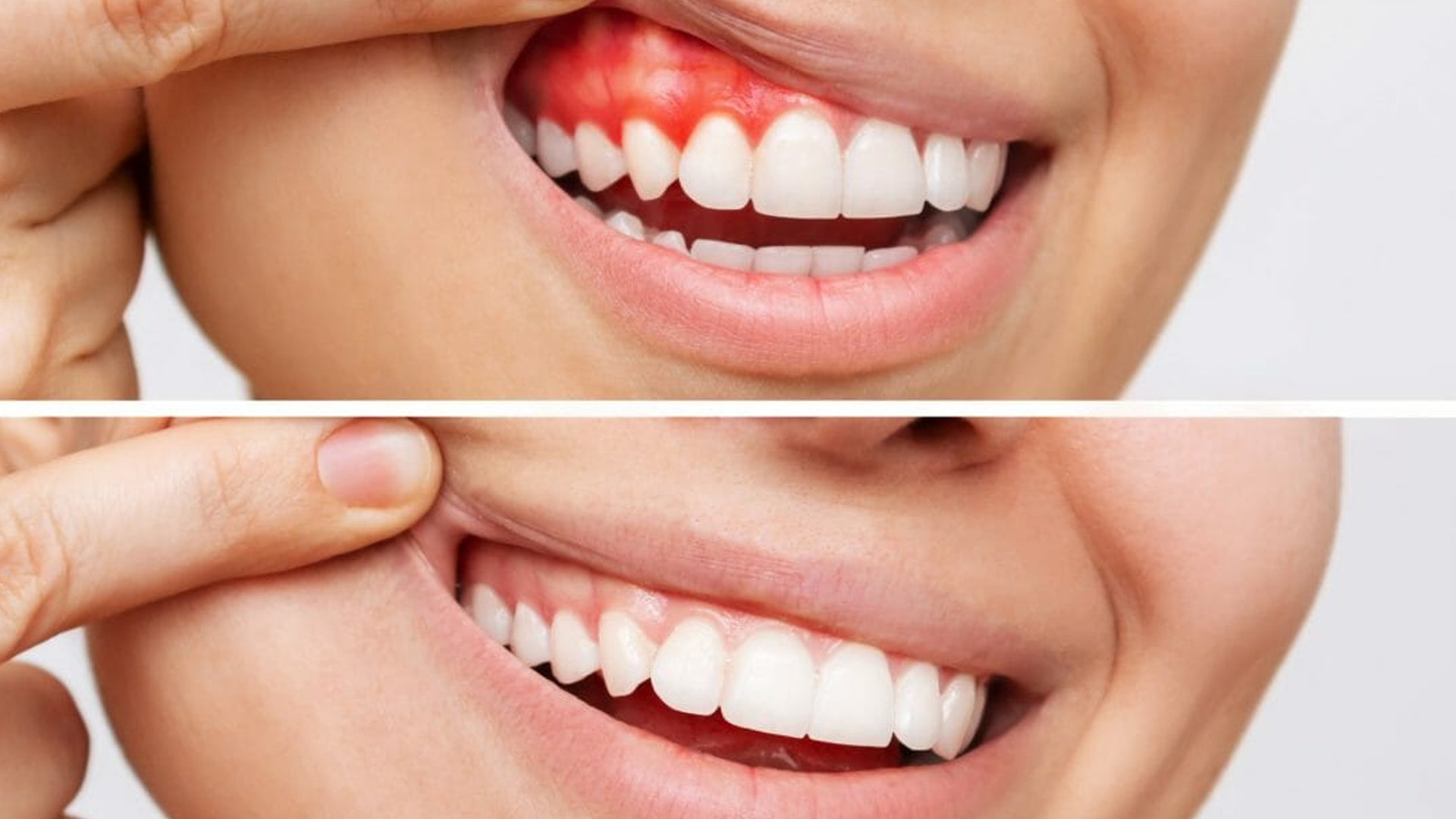 Periodontoloji (Diş Eti Tedavileri)